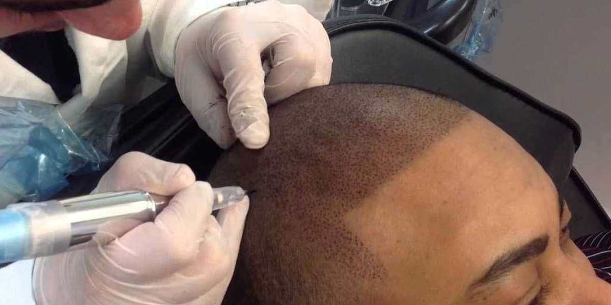 Scalp Micropigmentation Hair Loss