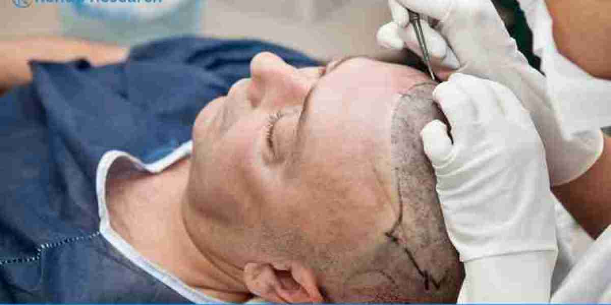 Hair Transplant Market Size, Share | Growth Forecast | 2028