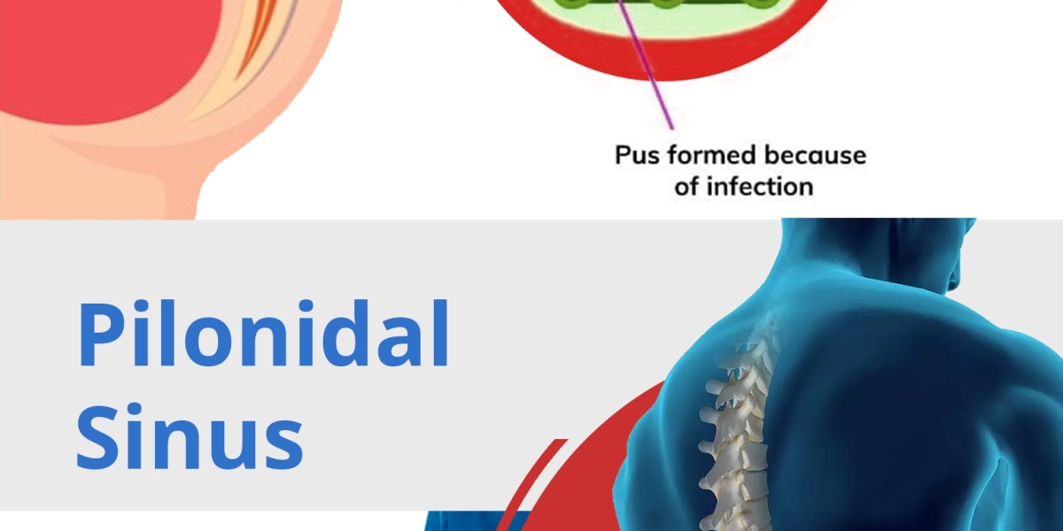 Dr. Tarun Mittal: Revolutionizing Pilonidal Sinus Treatment through Endoscopic Innovation in Delhi