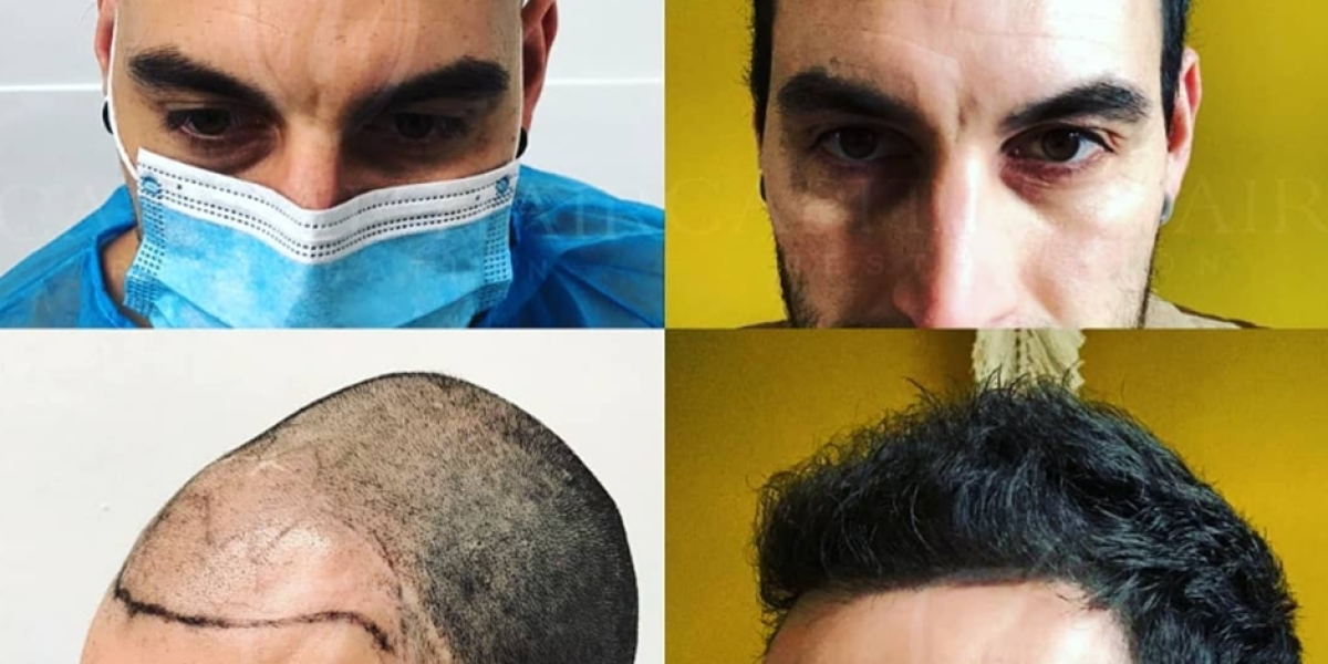 Unveiling the Secrets of Successful Hair Transplants in London