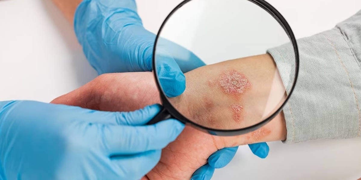 Spotlight on Skin Cancer Early Detection