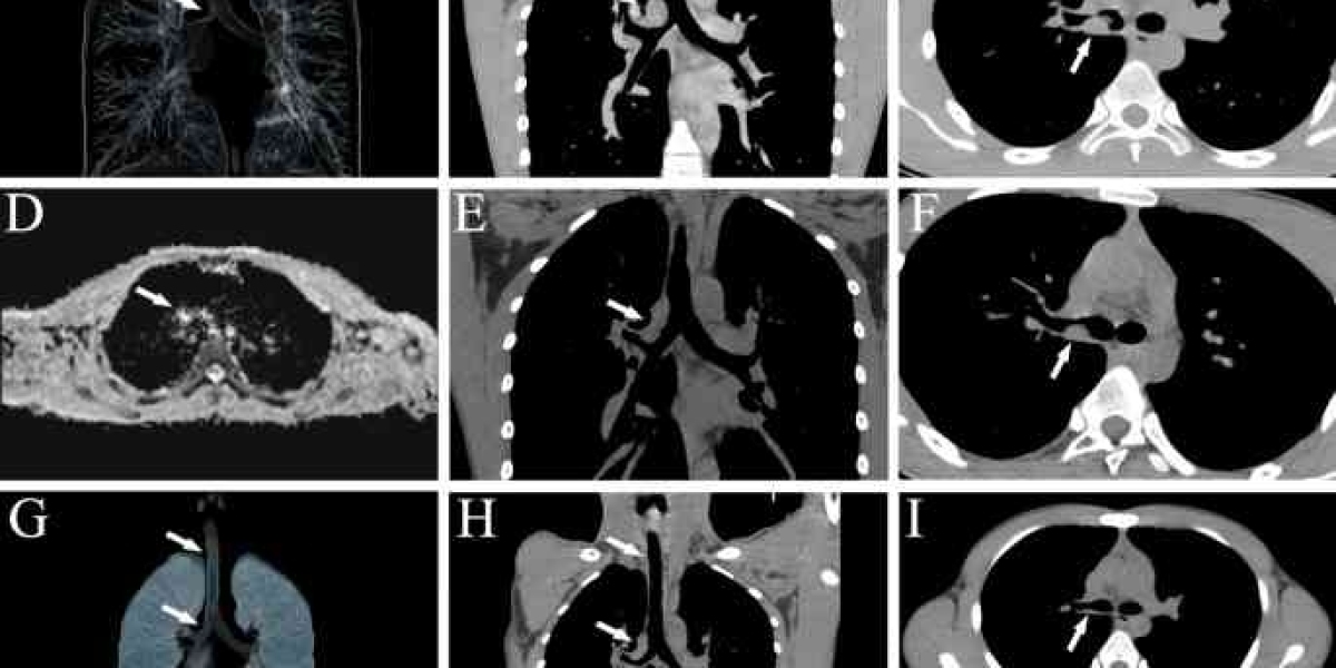 Rosai-Dorfman Disease (RDD) Therapeutics Market size is expected to reach USD 902.9 million by 2033