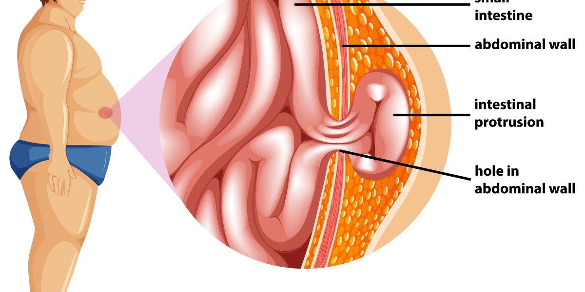 Understanding Different Types of Hernias