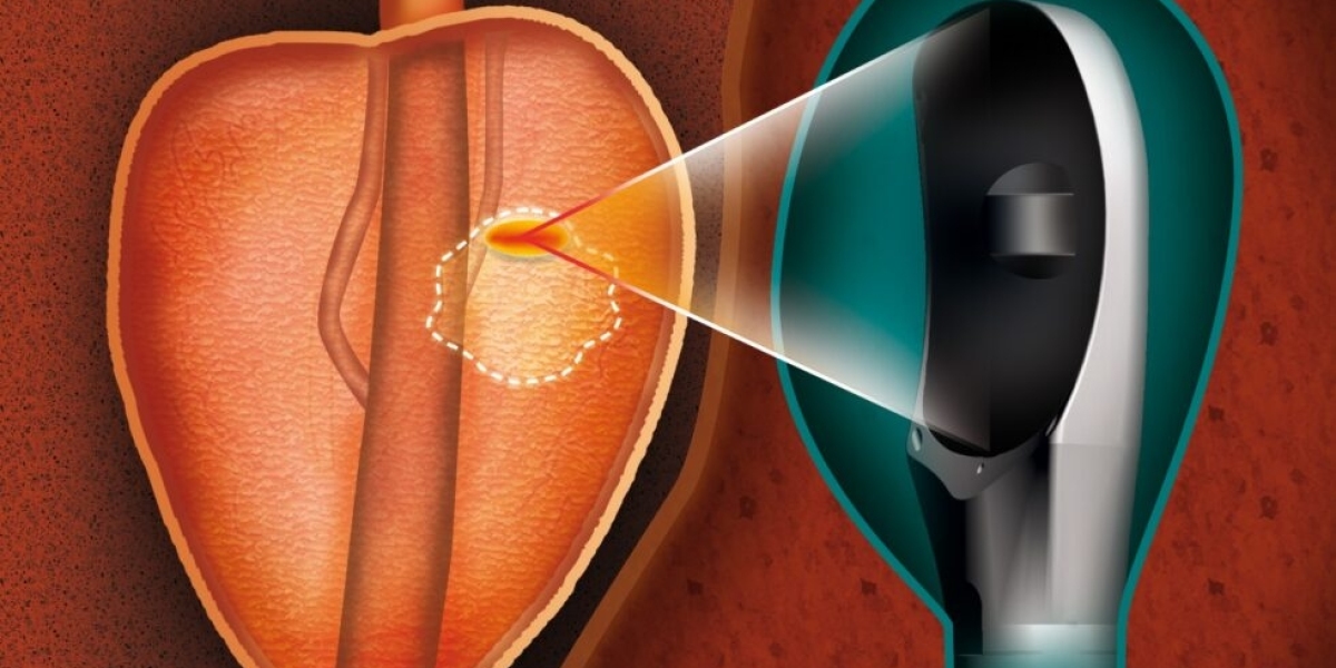 Focal Therapy for Prostate Cancer Therapeutics Market size is expected to grow USD 25412.48 million by 2033