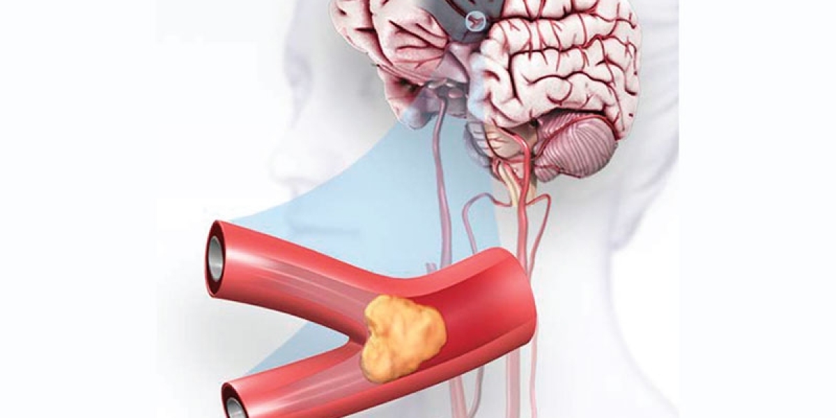 Ischemic Stroke Market: Statistics and Forecasts till 2024-2034