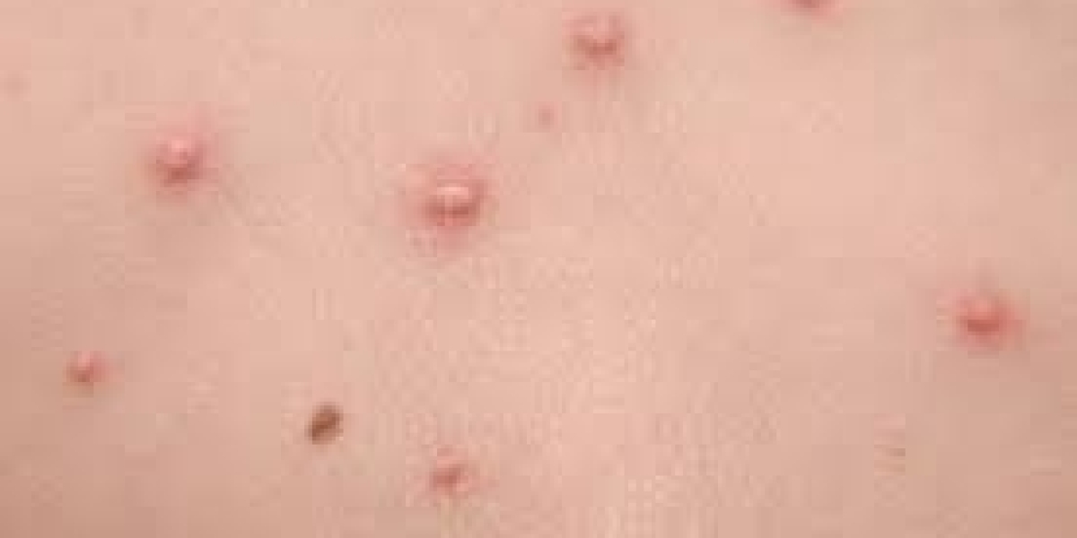 2023 Chickenpox Market | Report By 2033