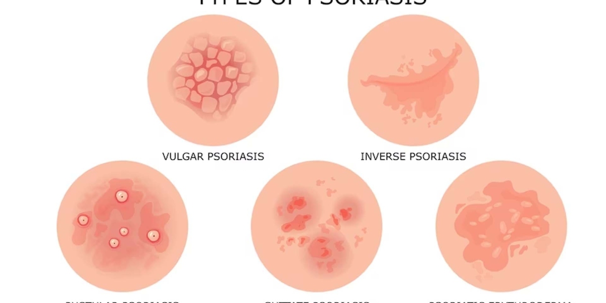 Plaque Psoriasis Market Size, 2023 Analysis, Industry Trends and Forecasts to 2033