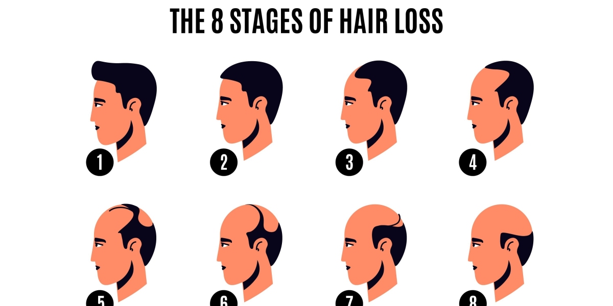 Is  Hair transplant is good option ?