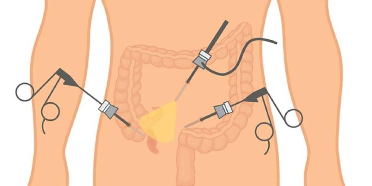 Best Laparoscopic Surgery in Delhi Dr. Tarun Mittal