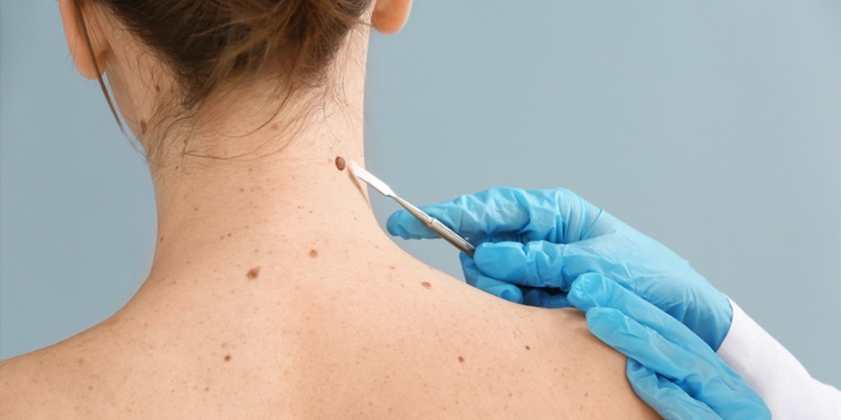 Confidence Renewed: Skin Lesion Removal in Dubai