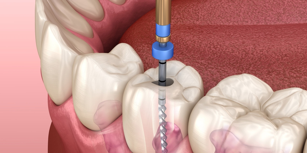 Global Root Canal Files Market Is Driven By Growing Prevalence Of Dental Diseases