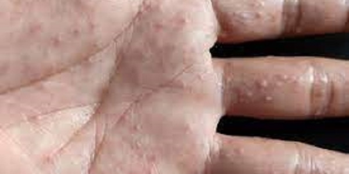 Hand Eczema Market Share, Epidemiology, Analysis & Trends 2024-2034