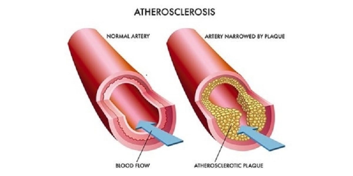 Atherosclerosis Market Share, Epidemiology, Analysis & Trends 2024-2034