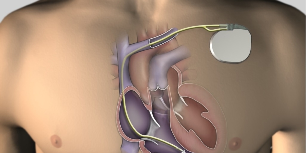 Brazil Cardiac Pacemakers Market Demand Is Driven By Technological Advancements