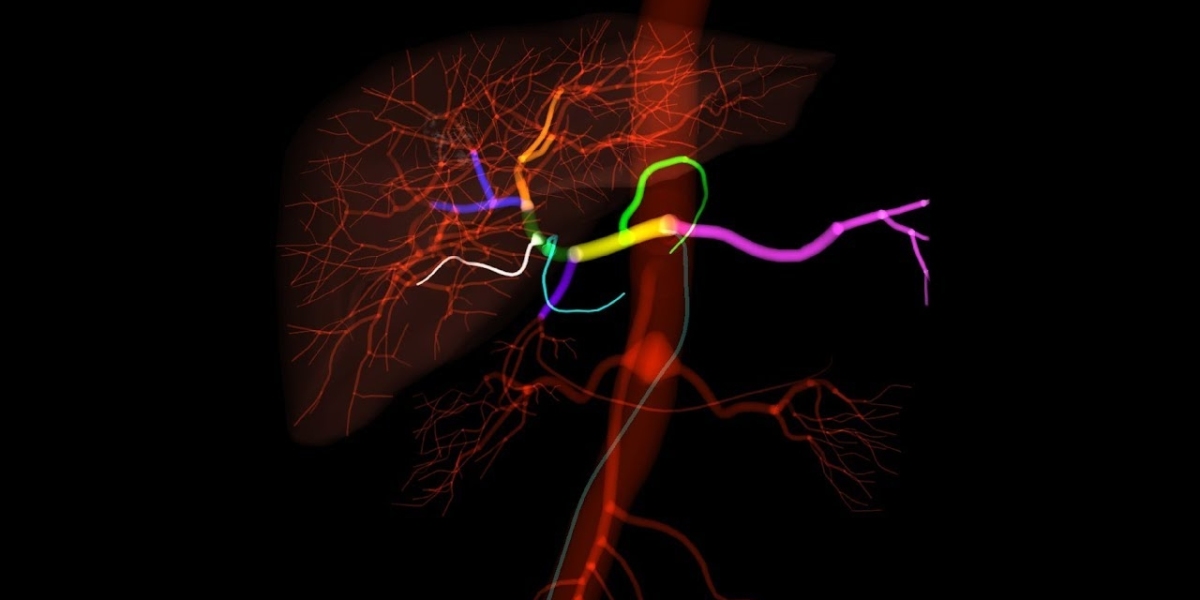 Embolization: A Minimally Invasive Procedure for Blocking Blood Flow