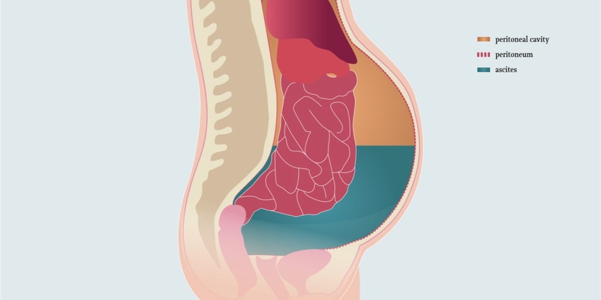 Ascites Market