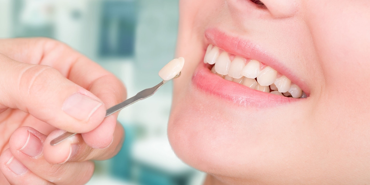 Crafting Smiles: Strategies For Success In The Global Dental Veneers Market