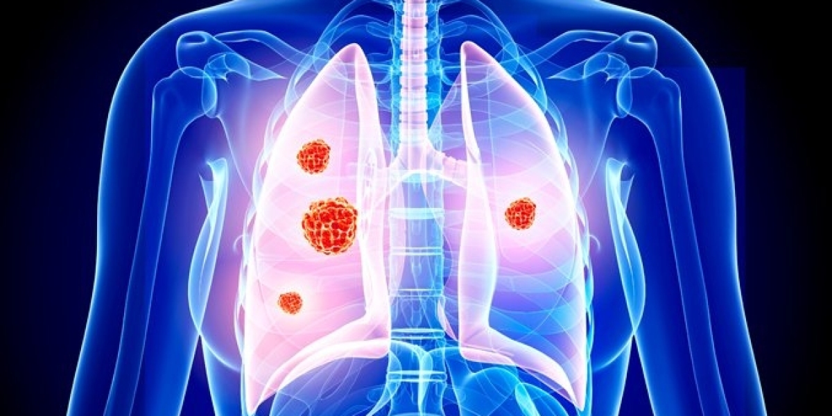 Non-Small Cell Lung Cancer (NSCLC) Market Size and Growth Rate Analysis for 2024-2034| by IMARC Group