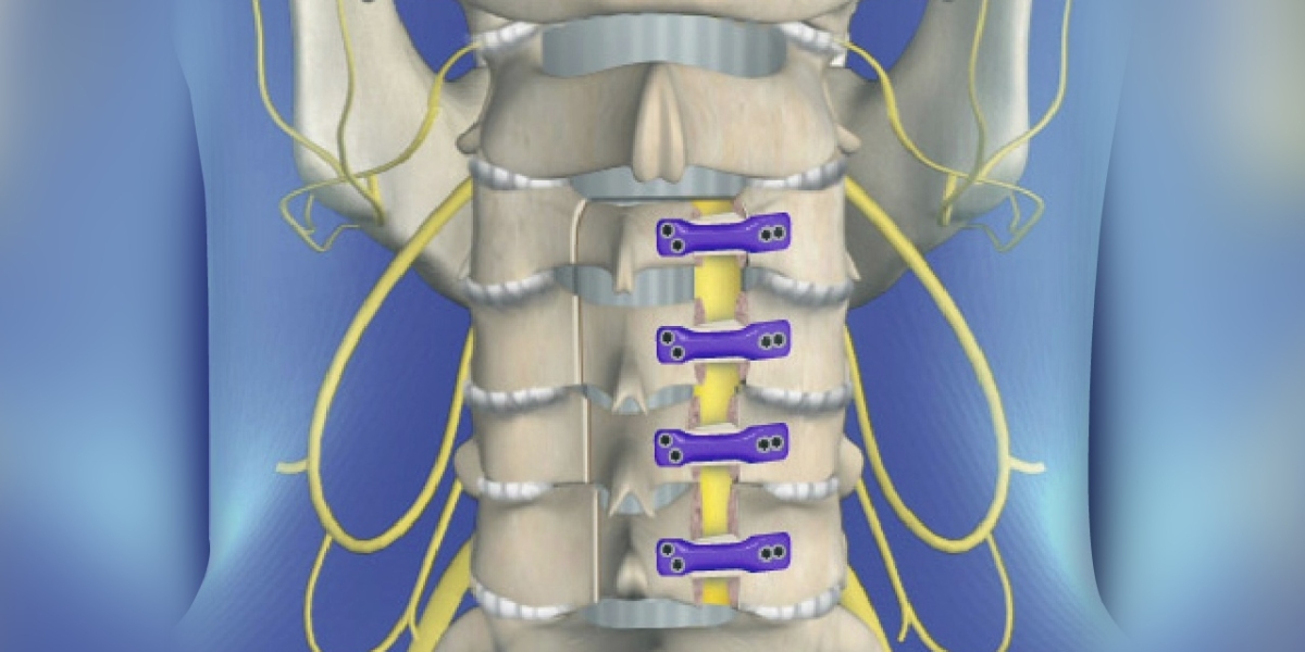 Spinal Laminoplasty Market: Exploring Growth Factors and Market Dynamics