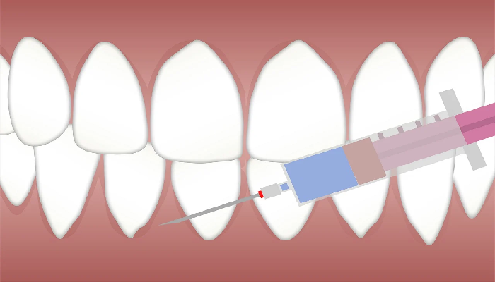 kill tooth pain nerve in 3 seconds permanently