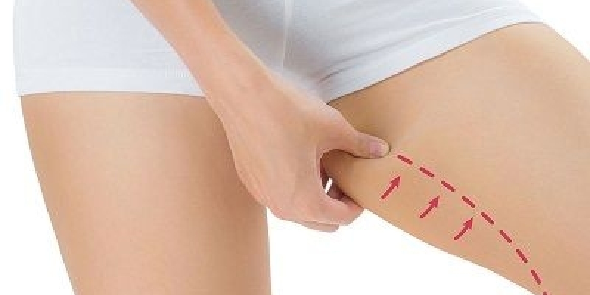 10 Treatments for Thigh Lifts in Dubai