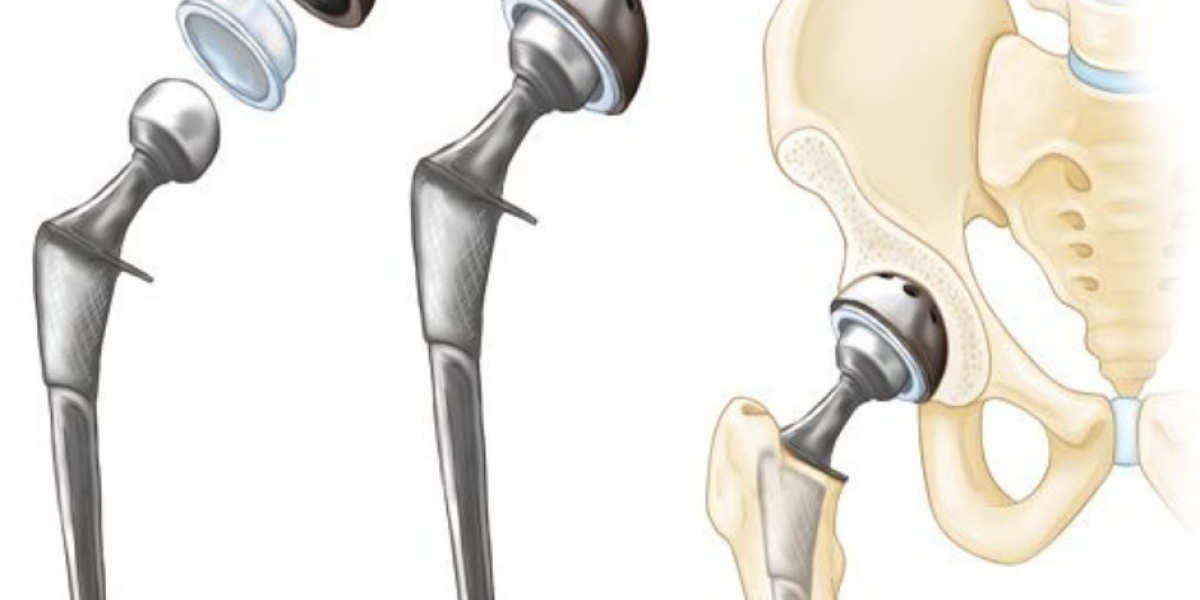 Hip Replacement Market: Pioneering Technologies Reshaping Joint Health