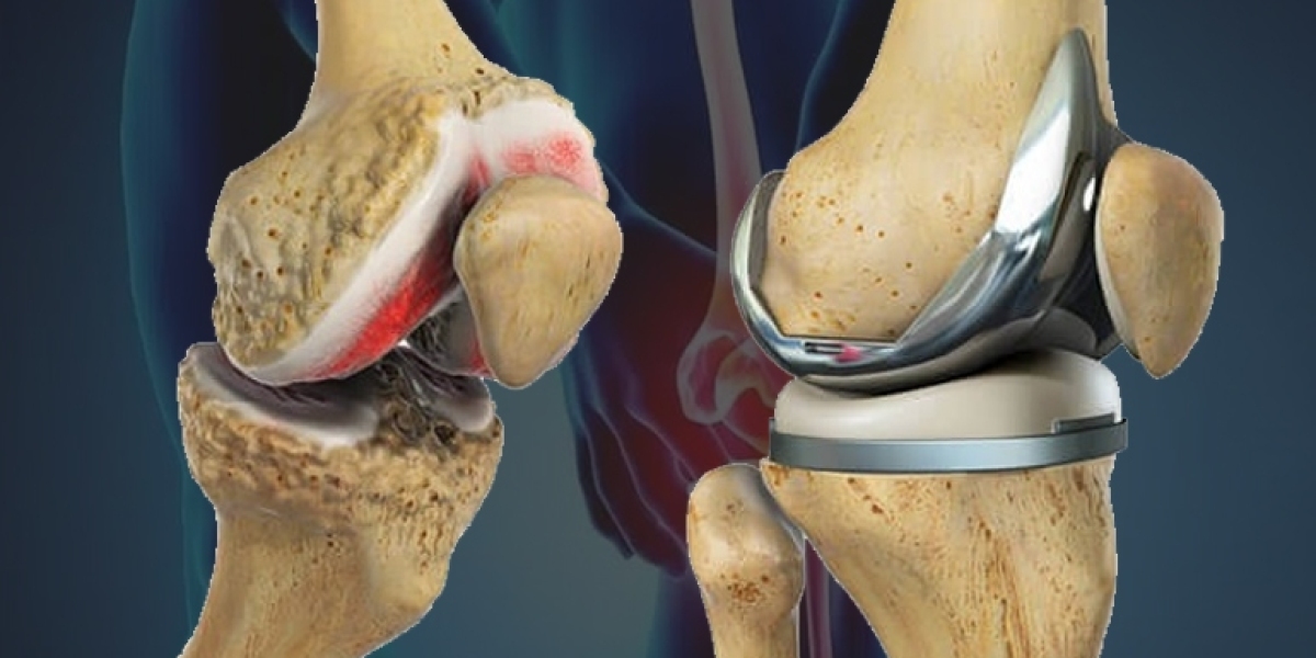 Pathway to Pain-Free Living: Understanding Knee Replacement Options