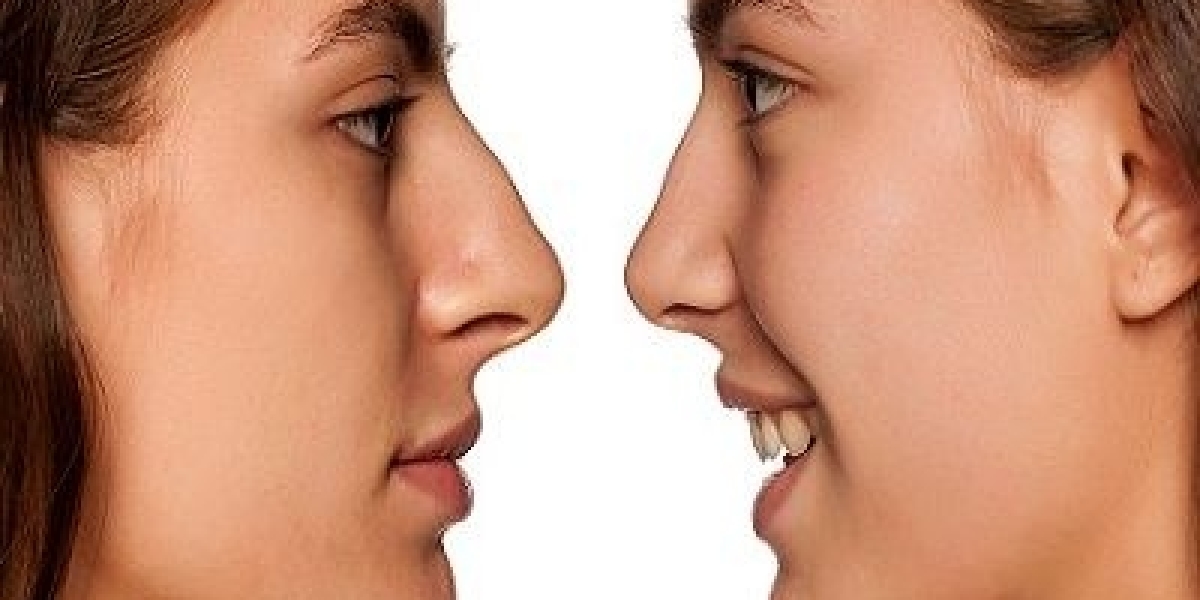 Can Rhinoplasty in Dubai Correct Breathing Problems?