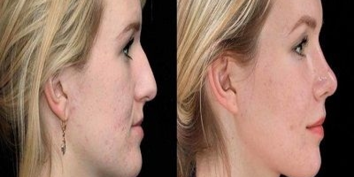 Top 10 Treatments for Chin Augmentation in Dubai: Where to Get the Best Results