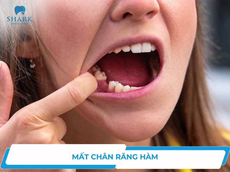 Mất chân răng hàm có ảnh hưởng gì? Khắc phục bằng cách nào?