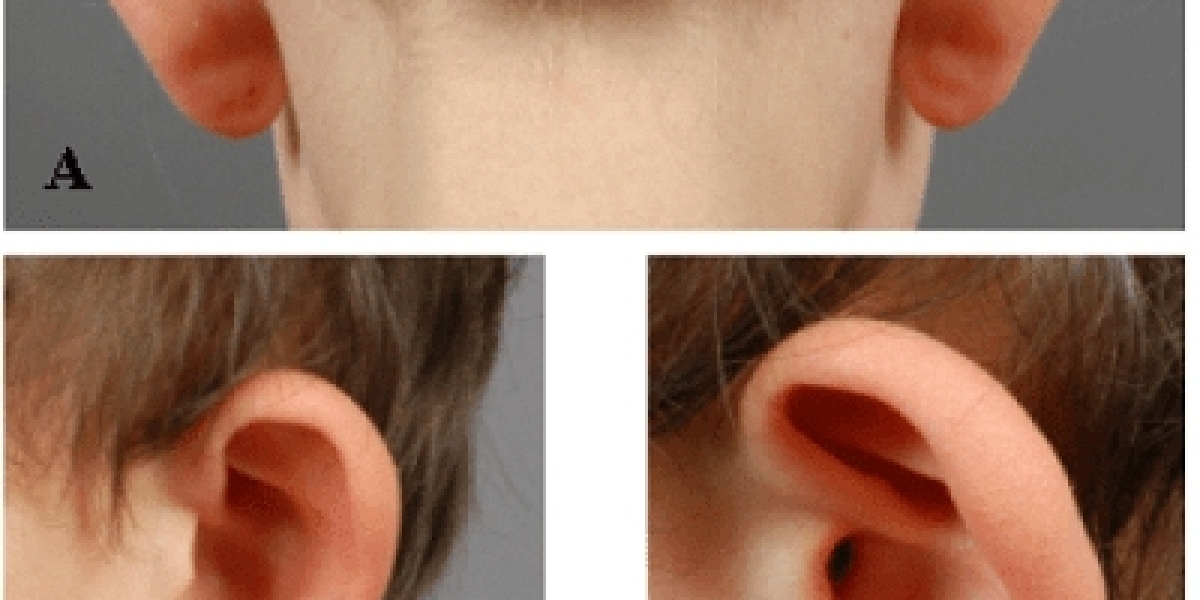 Top 7 Benefits of Ear Surgery in Dubai