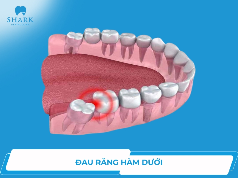 Bị đau răng hàm dưới điều trị như thế nào?