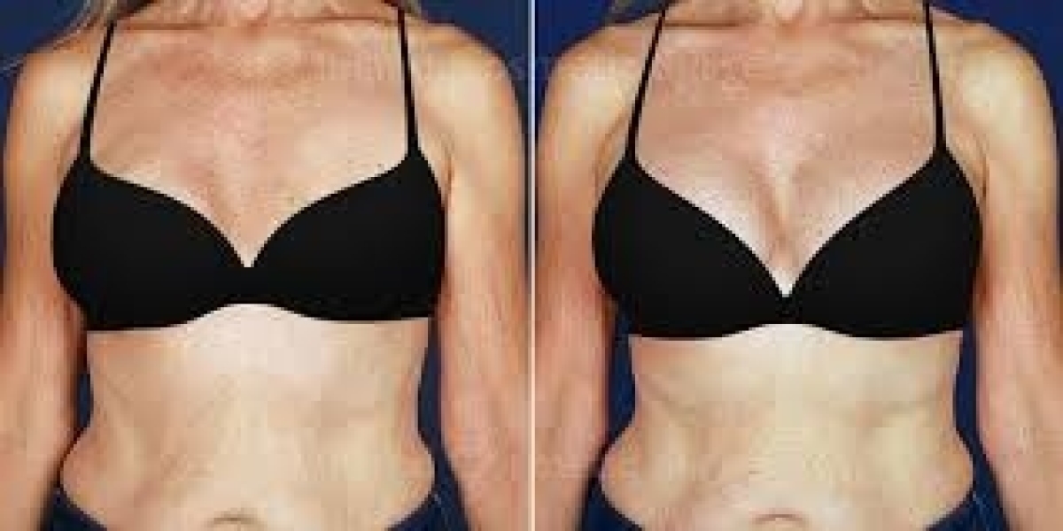 How Breast Augmentation Revision Surgery Works