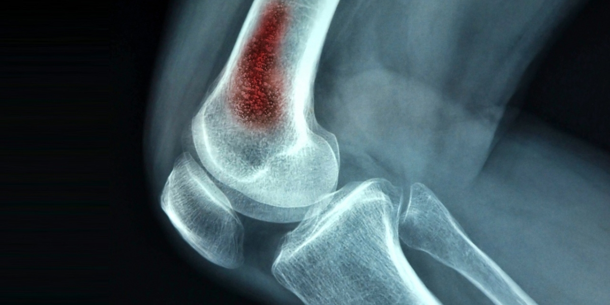 Osteomyelitis Market: Epidemiology, Size, Share, Analysis and Forecast till (2024-2034)