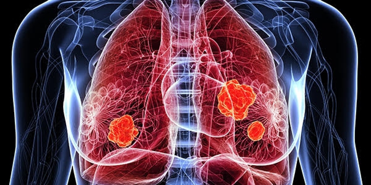 Extensive-Stage Small Cell Lung Cancer Market Analysis, Epidemiology, Trends and Forecast till (2024-2034)