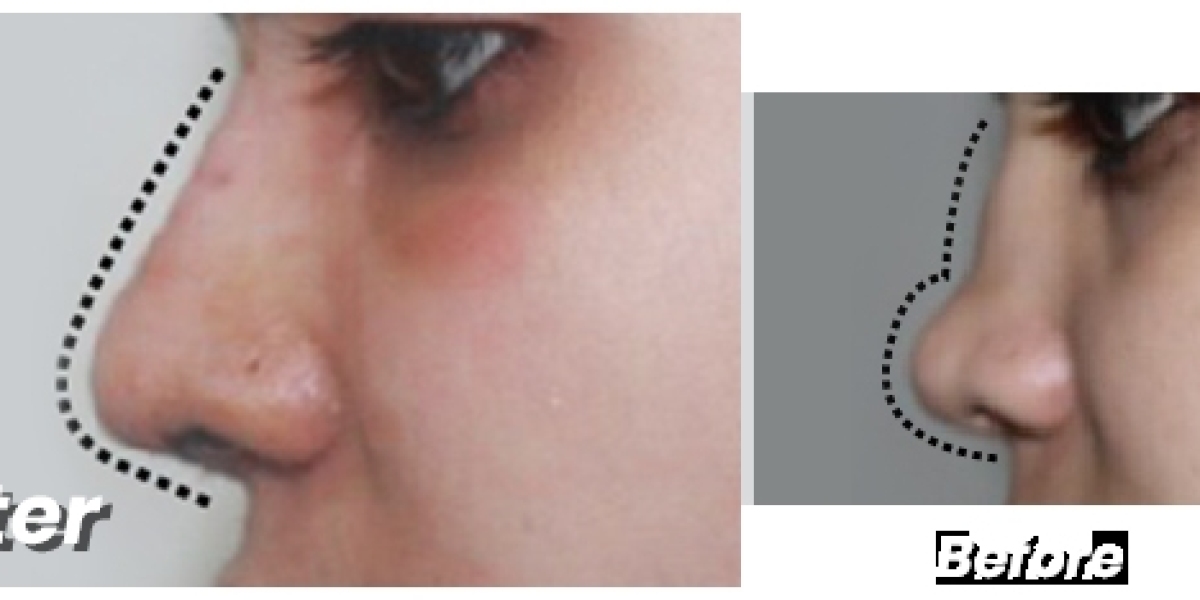 Rhinoplasty in Lahore: Expert Care with the Best Rhinoplasty Surgeon at Cosmeticoplasty