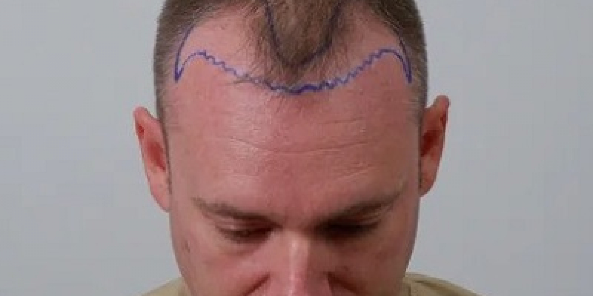 What Happens 10 Years After a Hair Transplant?