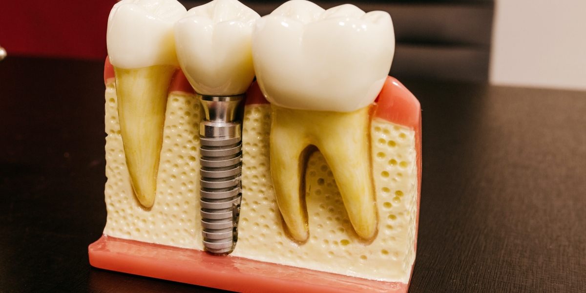 Dental Implants in Dartford: The Best Solution for Missing Teeth