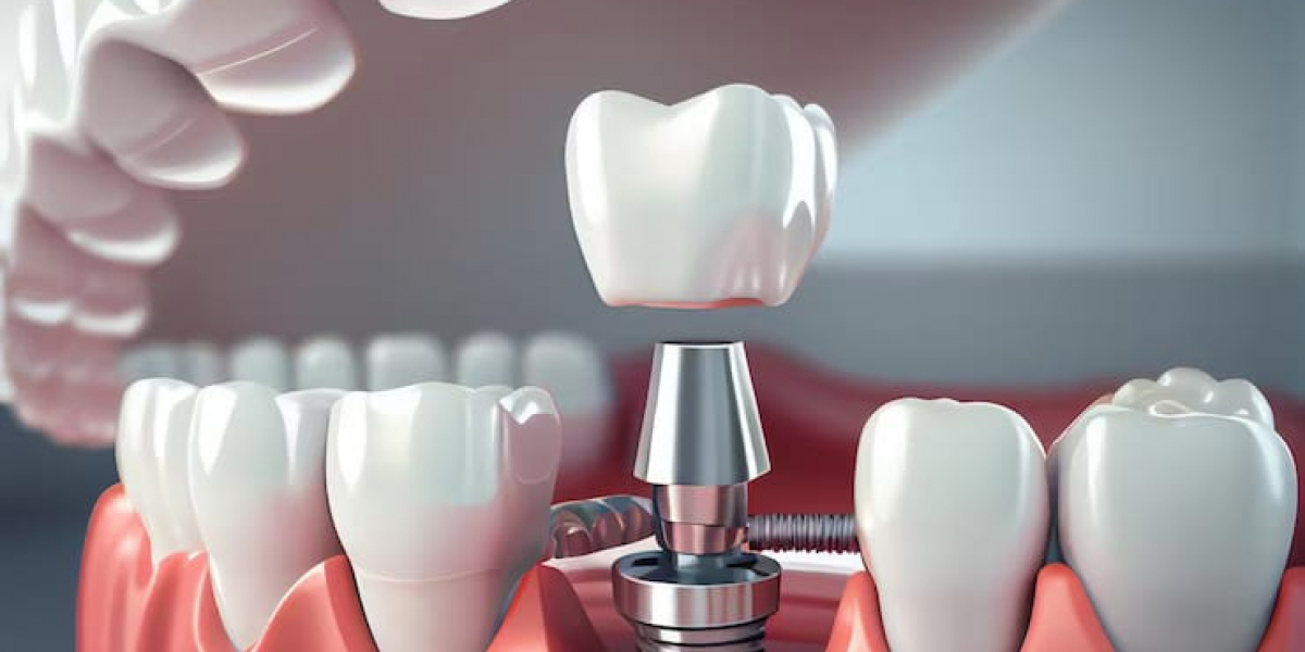 Is a Dental Implant the Right Choice for You? Find Out Now!