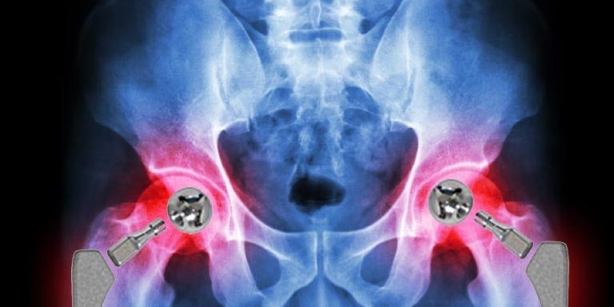 Stryker Lawsuit: Understanding the Legal Battles and Patient Rights